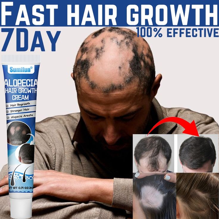 Reduces Hair Loss | Sumifun Hair Growth Cream ORIGINAL | Stronger Hair 100%