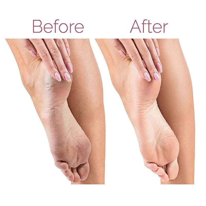 Electric Foot File Callus Remover | Rechargeable Pedicure Foot Care Tool