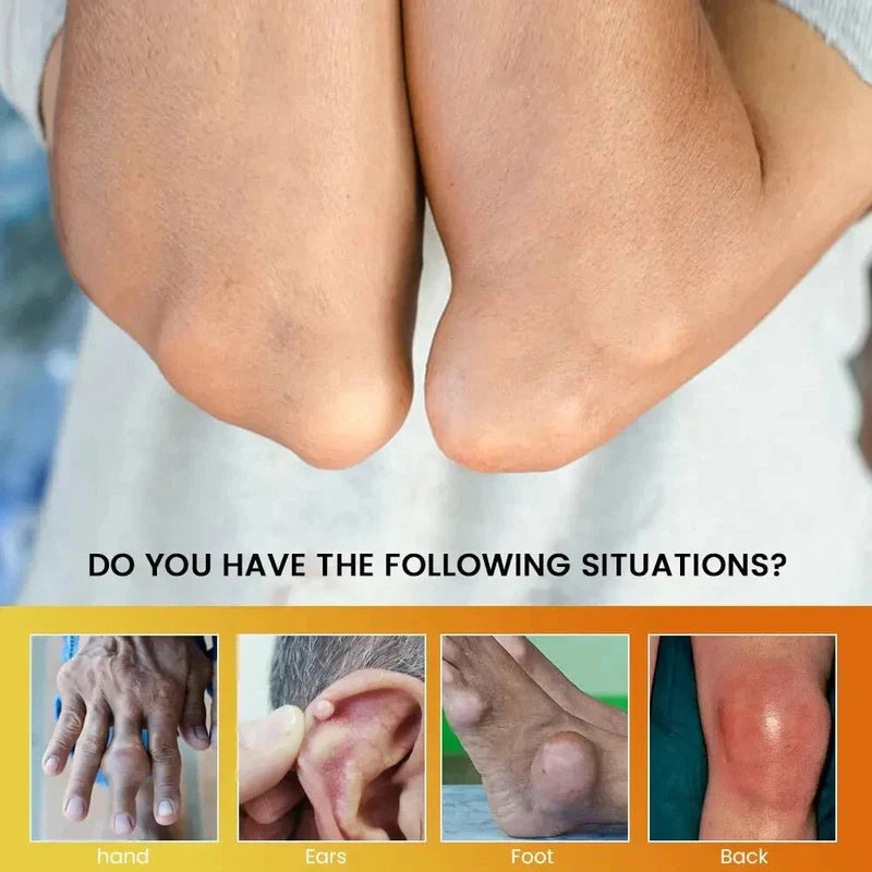 Sumifun Anti-Gout Cream – Joint Pain Relief & Comfort Formula 🌿